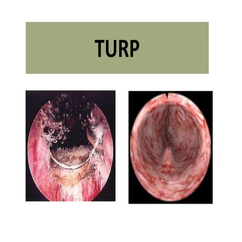 Turp techniques