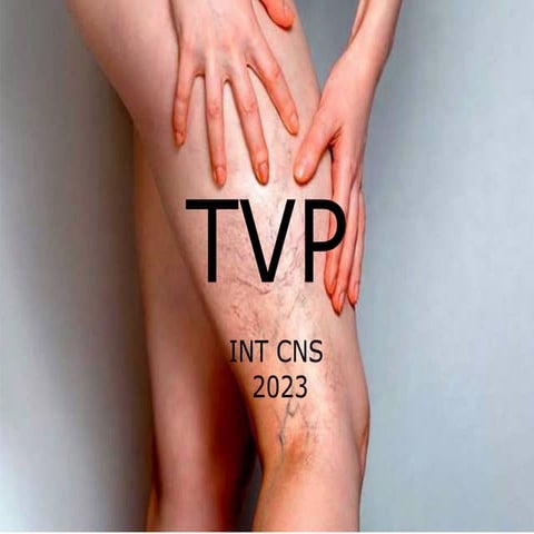 Comprehensive Overview of Deep Vein Thrombosis (TVP): Anatomy ...
