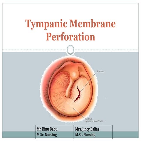 Tympanic membrane perforation | PPT