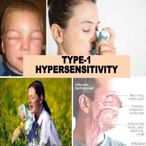 Type 1 hypersensitivity