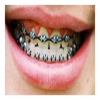 Types of braces