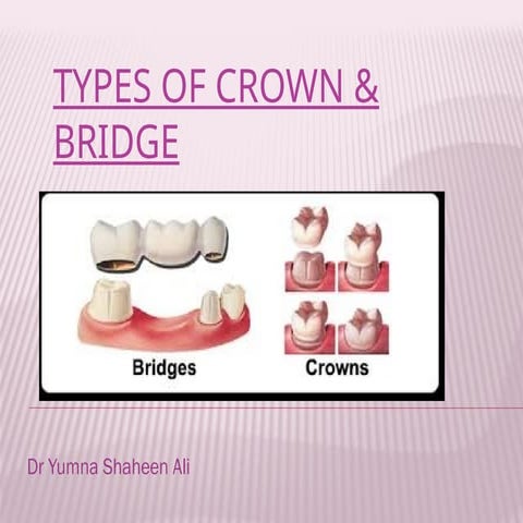 Types of special crownsand bridges in FPD