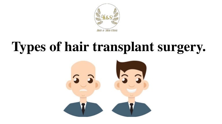 Types Of Hair Transplant Surgery
