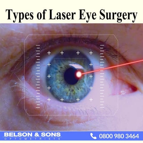 Types of Laser Eye Surgery