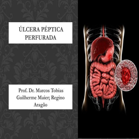 Comprehensive Management of Perforated Peptic Ulcer: Diagnosis to ...