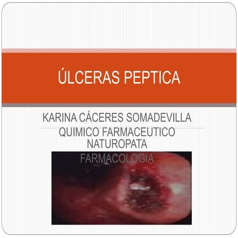 ULCERA PEPTICA (1).ppt para enfermeria y