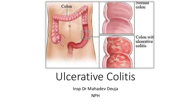 Ulcerative colitis diagram of colitis 