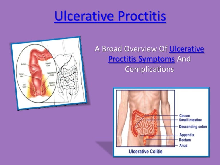 home remedies for ulcerative proctitis