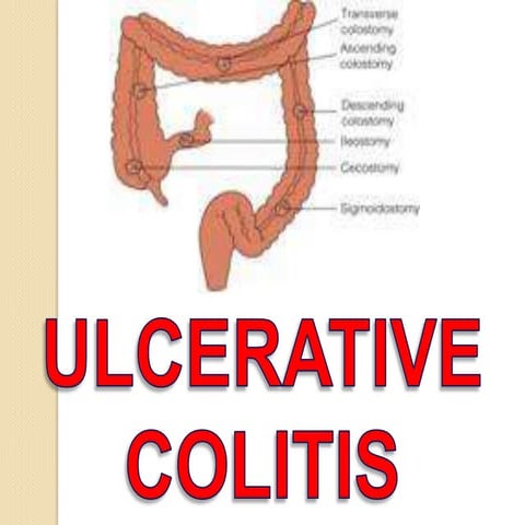Ulcerative Colitis 
