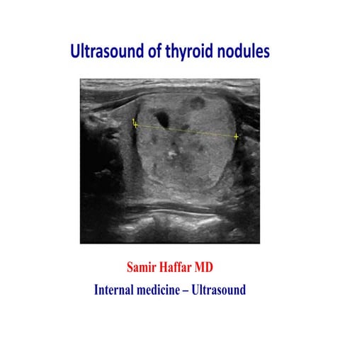 Ultrasound of thyroid nodules