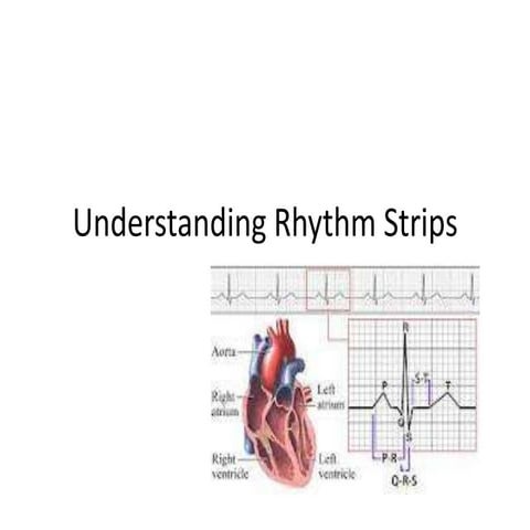 Understanding rhythm strips