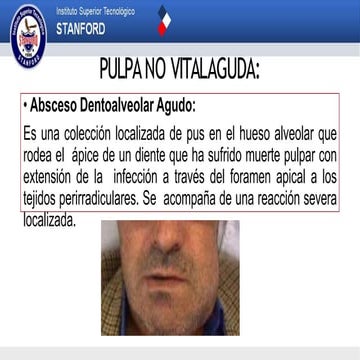 Unidad 4 pulpa no vital aguda