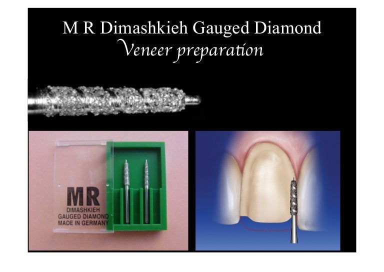 Veneers preparation using M R Dimashkieh self limiting bur