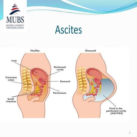 Ascites definition, causes, clinical manifestations,diagnosis .pptx