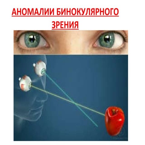 аномалии бинокулярного зрения. Upgraded