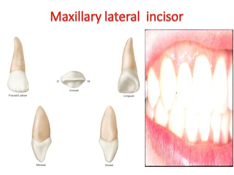 Upper Lateral Incisor