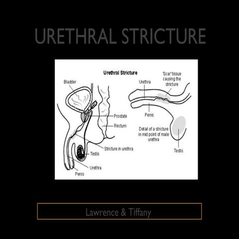 Urethral stricture period 1 