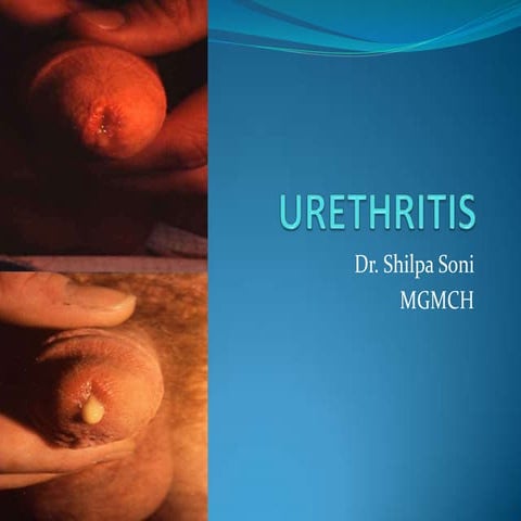 Urethritis