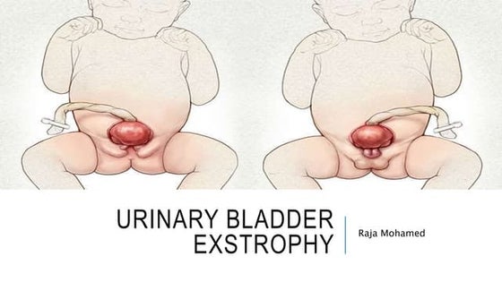 Exstrophy of bladder | PPTX