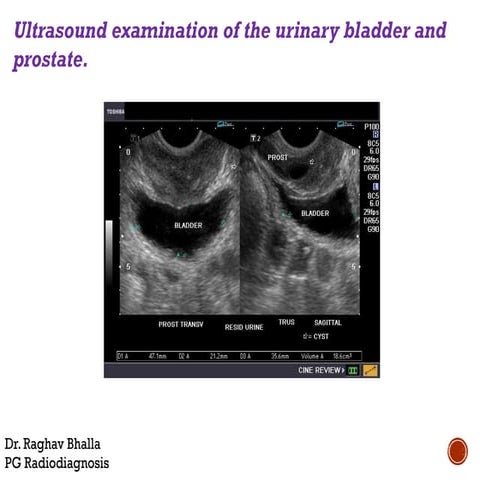 Urinary bladder pathologies | PPTX