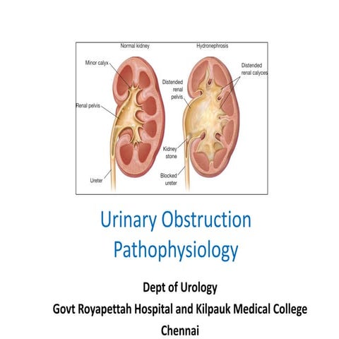 Urinary obstruction pathophysiology