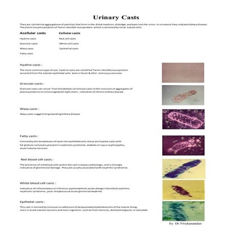 Urine casts &crystals
