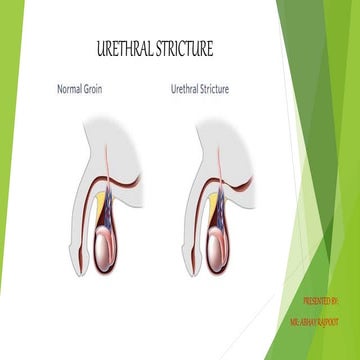 Ureteral stricture | PPTX