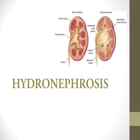 Urology 4 hydronephrosis