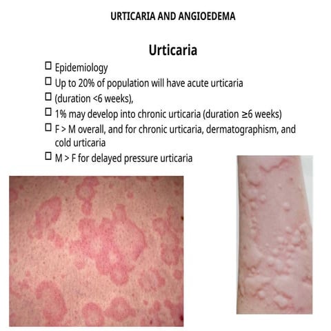 Urticaria | PPTX