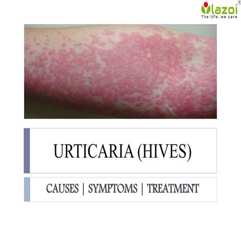 Urticaria (Hives) : causes, symptoms and treatments