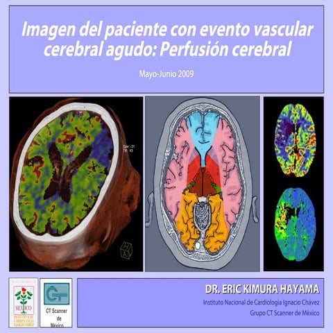 Prefusion cerebral. EKT