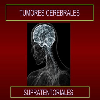 Tumores supratentoriales LQR