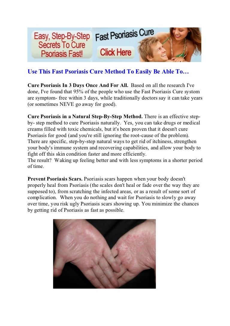 psoriasis home remedies natural remedies for psoriasis