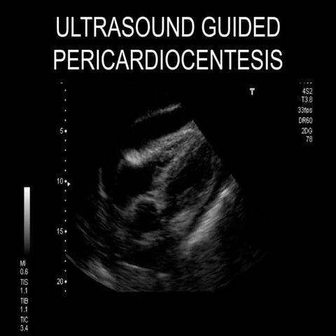 Ultrasound Guided Pericardiocentesis