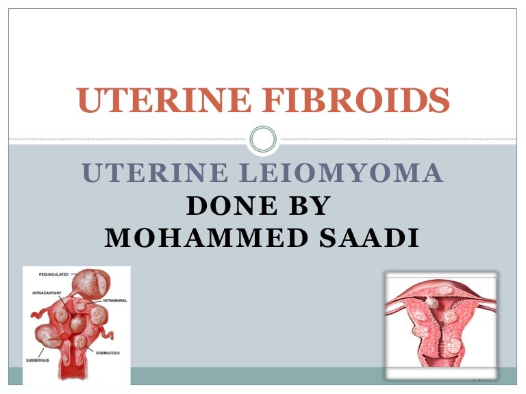 uterine fibroids powerpoint presentation