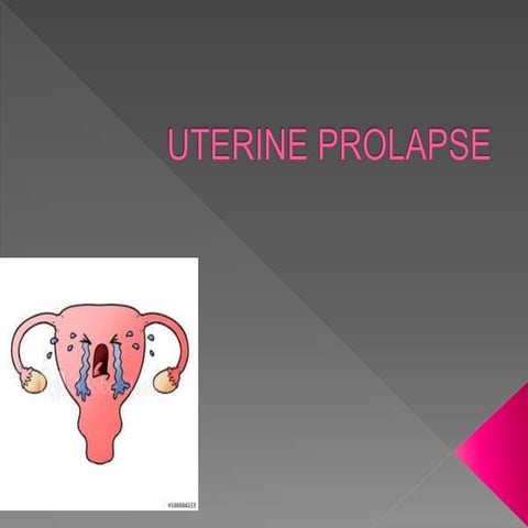 Parametritis/ Pelvic Cellulitis | PPTX
