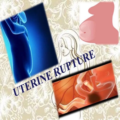 Uterine rupture