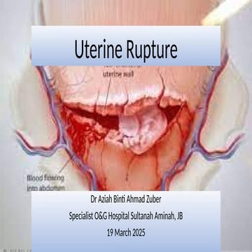 Rupture of the uterus | PPTX