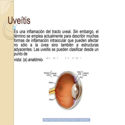 Uveítis