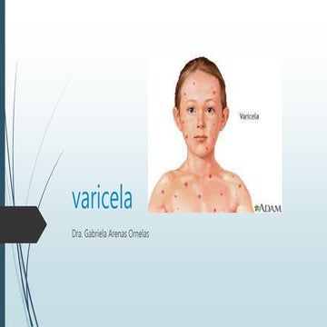 Varicela