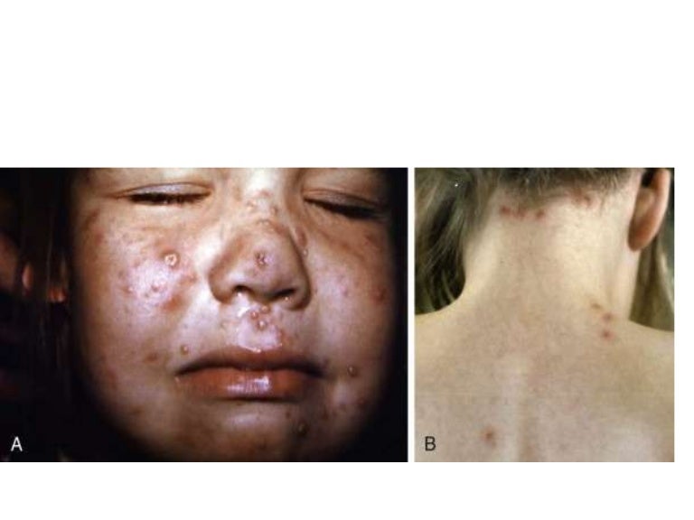 Varicella zoster virus infections