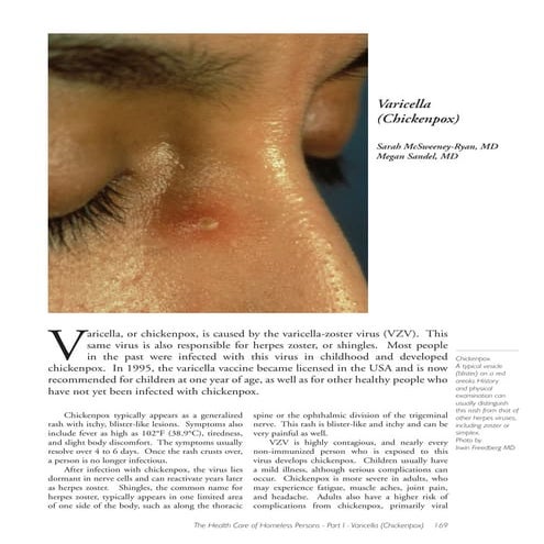 Varicella chickenpox