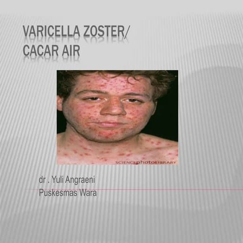 Varicella zoster