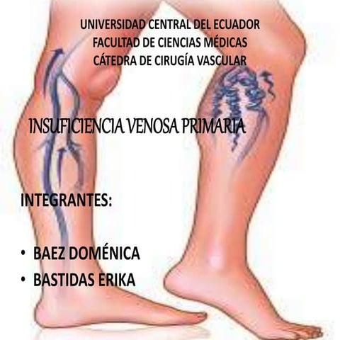 Insuficiencia venosa | PPTX