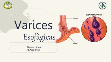 Varices esofagicas.pptx
