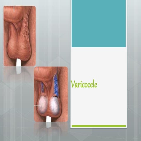 Varicocele 