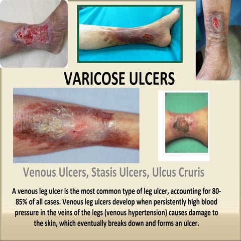 VARICOSE ULCERS