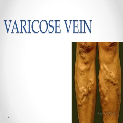 Varicose vein