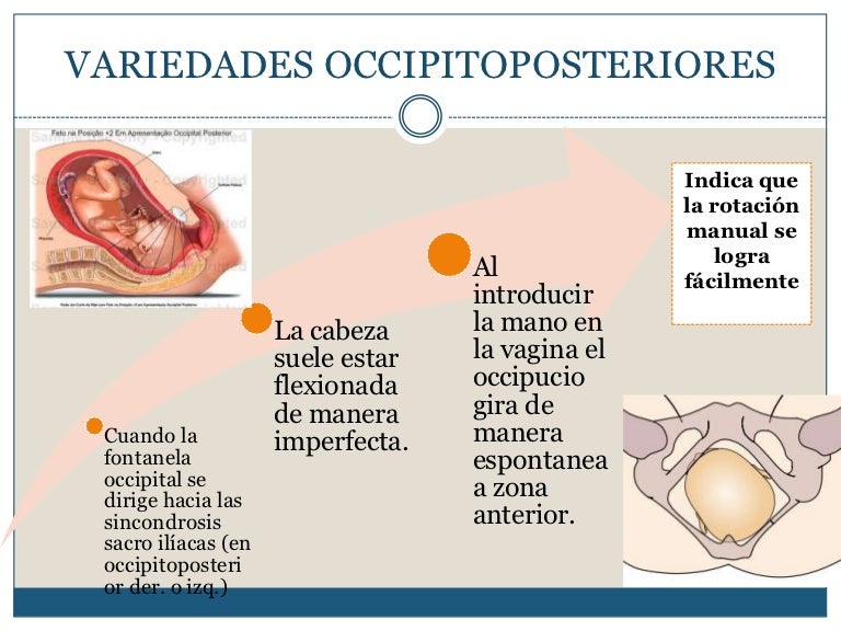 Variedades occipitoposteriores