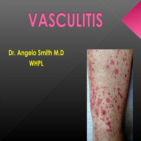 Vasculitis